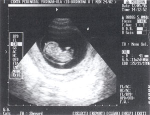 Эмбрион внутри амниотической полости. ТВ-сканирование.