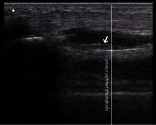 Рис. 1. Ультразвуковое изображение трубчатой кости